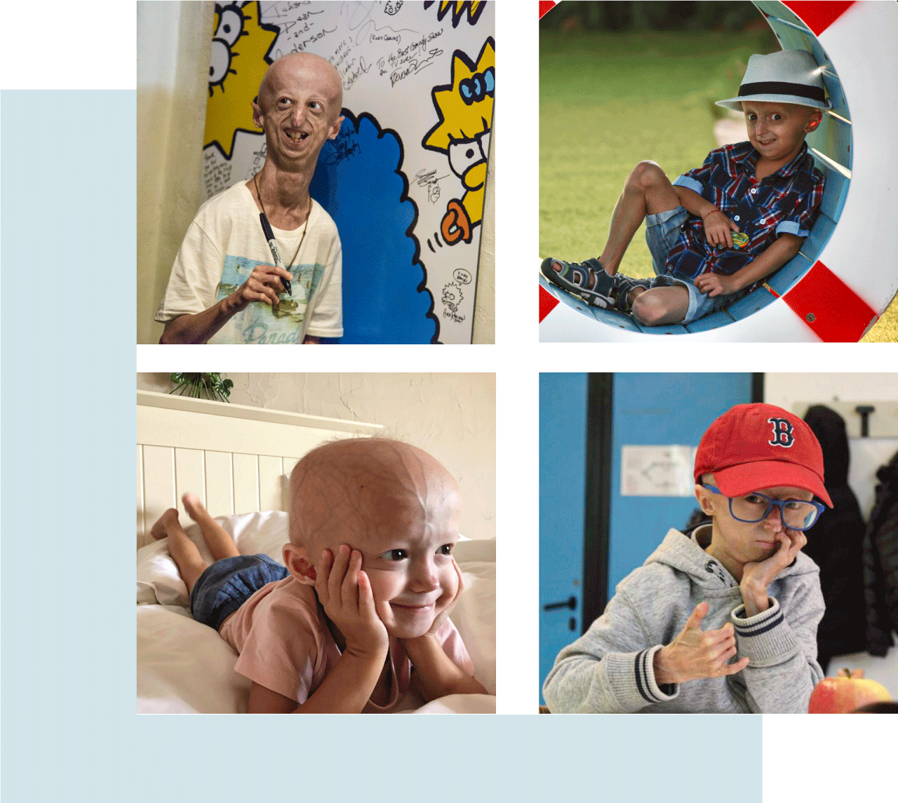foto-pazienti-progeria
